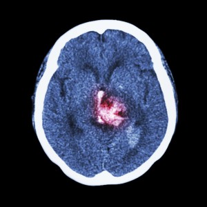 CT scan of brain : show hemorrhagic stroke